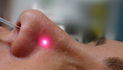 Konxa (Burun əti) kiçildilməsində radiofrekans üsulu 2